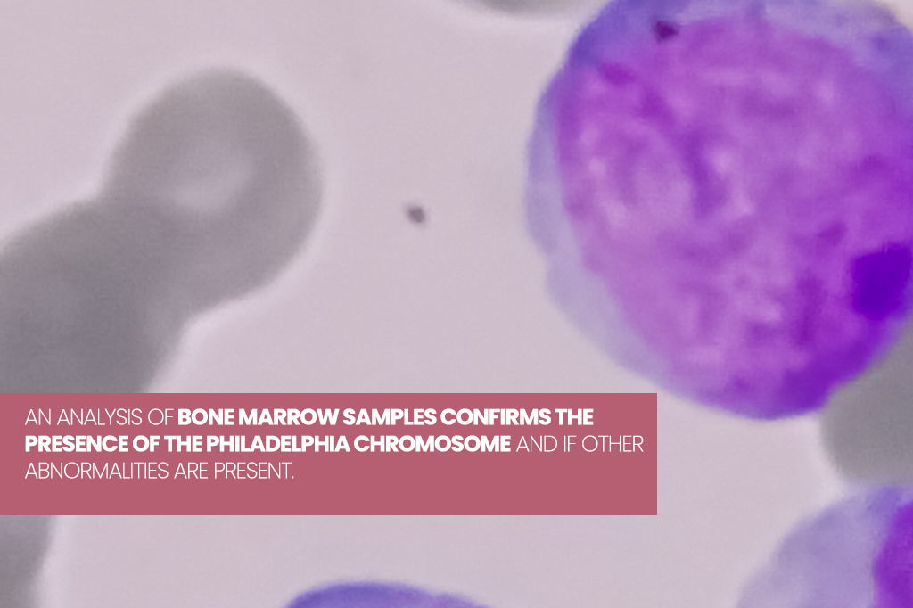 CML, Bone Marrow Biospy